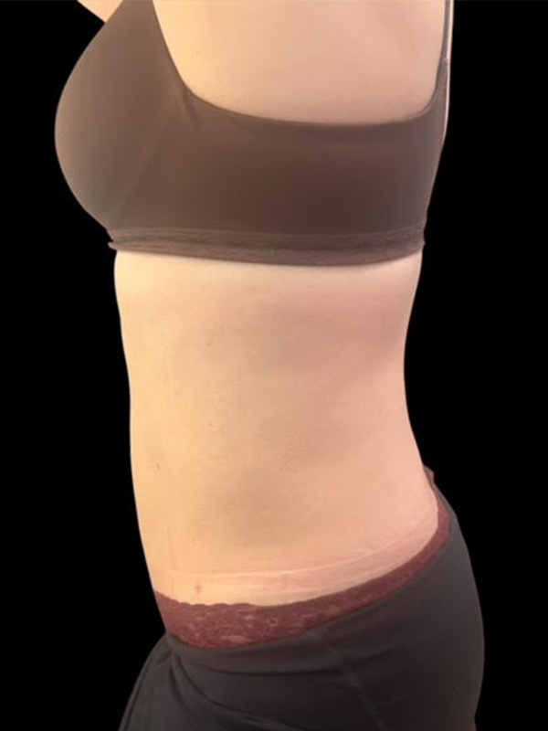 Liposuction Before & After Gallery - Patient 388372 - Image 2