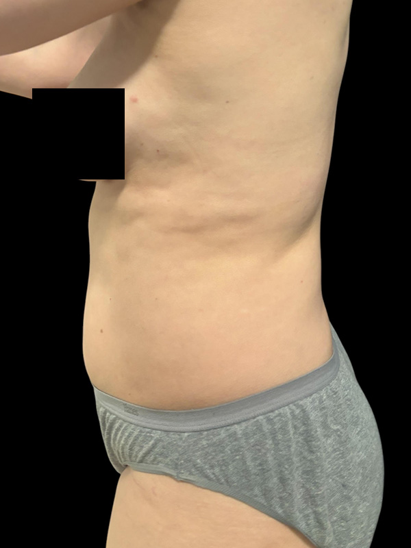 Liposuction Before & After Gallery - Patient 388372 - Image 1