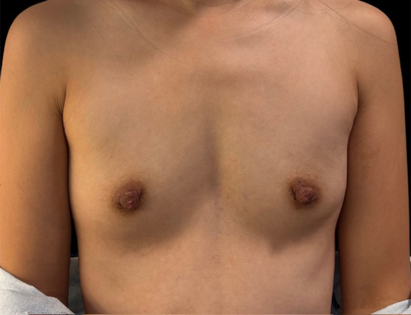 Breast Augmentation Before & After Gallery - Patient 414391 - Image 1