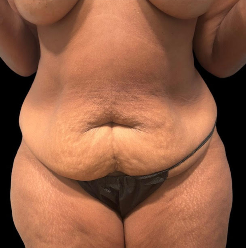 Abdominoplasty Before & After Gallery - Patient 304701 - Image 1