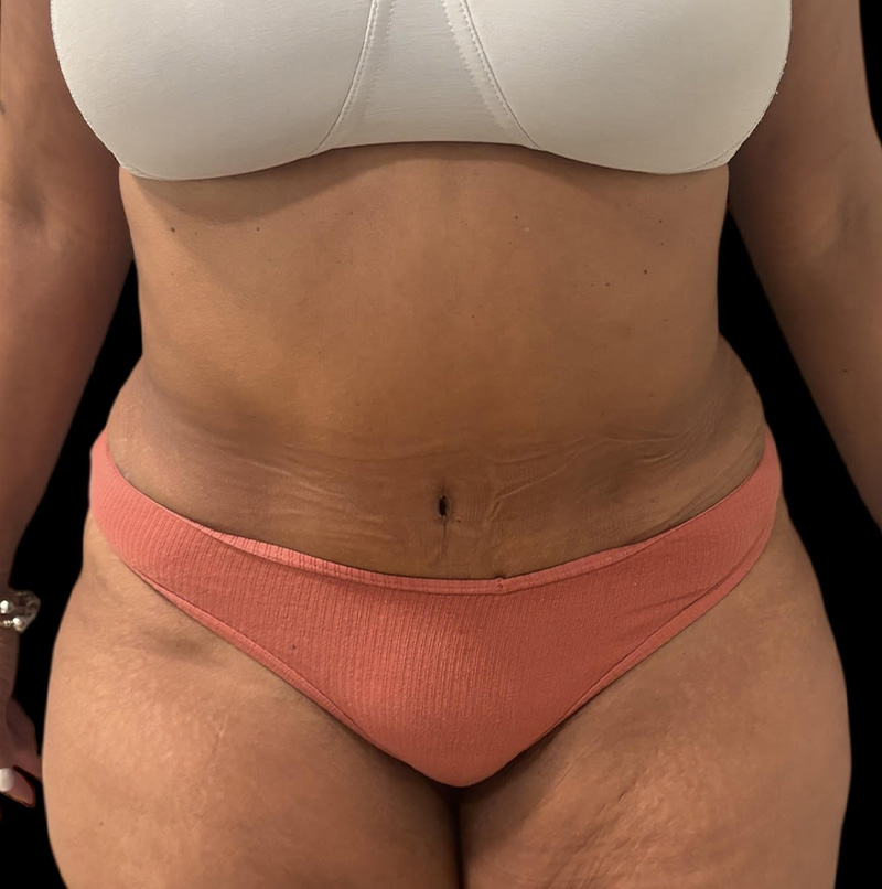 Abdominoplasty Before & After Gallery - Patient 304701 - Image 2