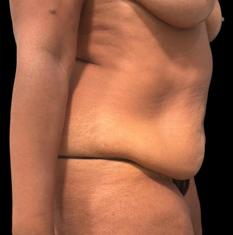 Abdominoplasty Before & After Gallery - Patient 304701 - Image 3