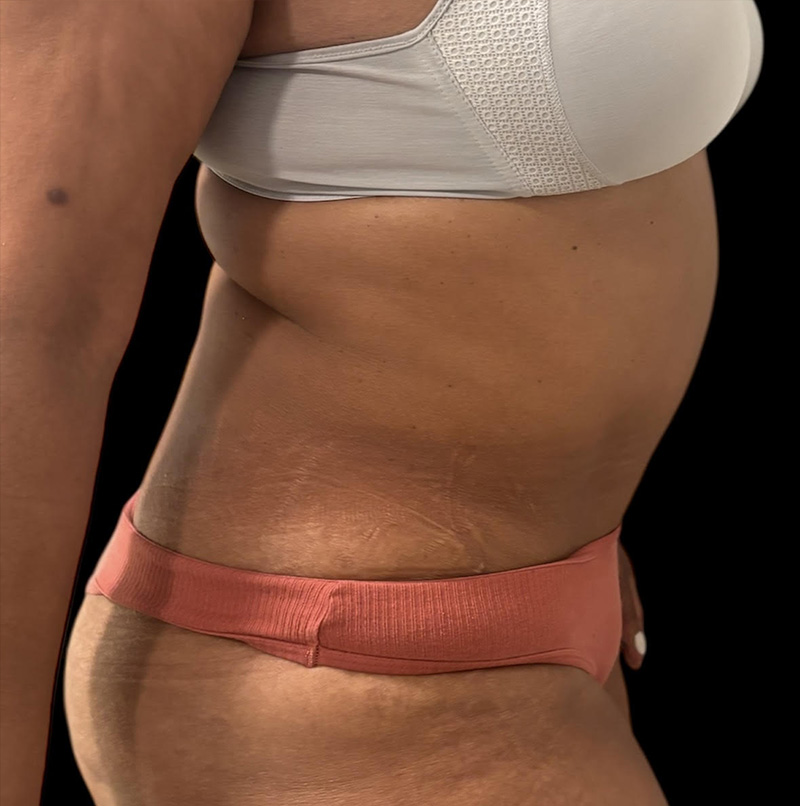 Abdominoplasty Before & After Gallery - Patient 304701 - Image 4