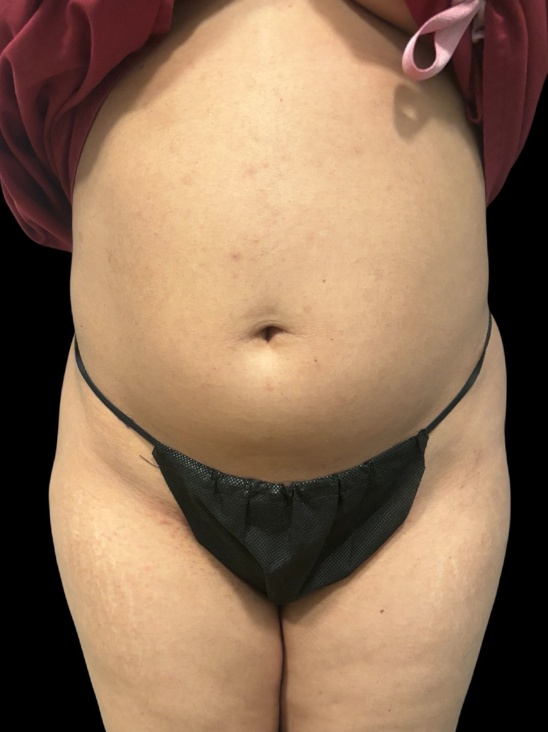 Liposuction Before & After Gallery - Patient 224824 - Image 1