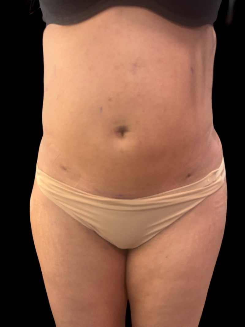 Liposuction Before & After Gallery - Patient 224824 - Image 2