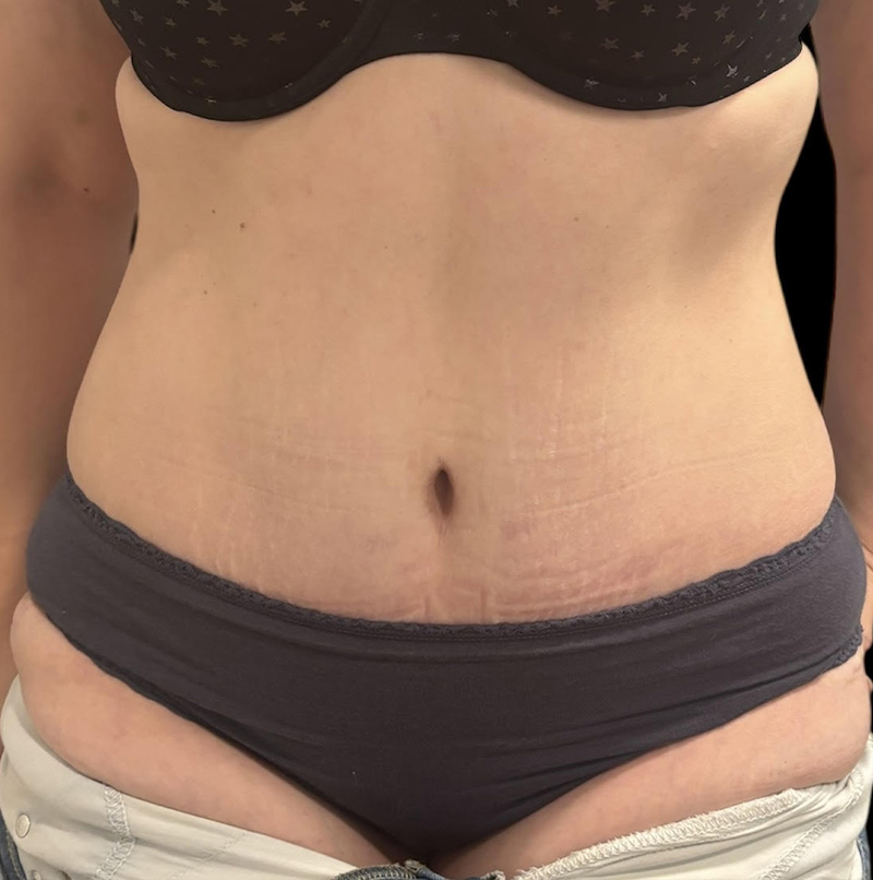 Abdominoplasty Before & After Gallery - Patient 403191 - Image 2