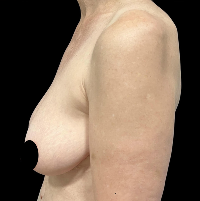 Breast Lift Before & After Gallery - Patient 411723 - Image 1