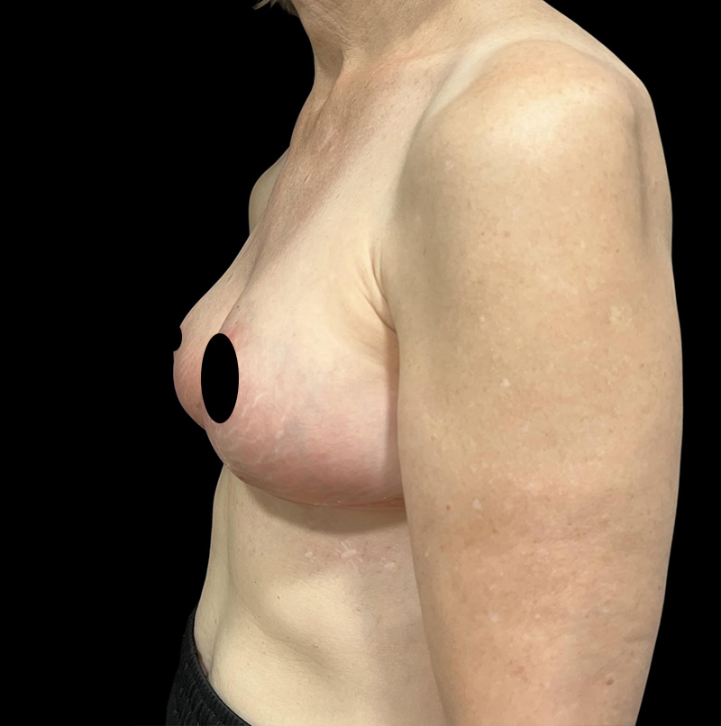 Breast Lift Before & After Gallery - Patient 411723 - Image 2
