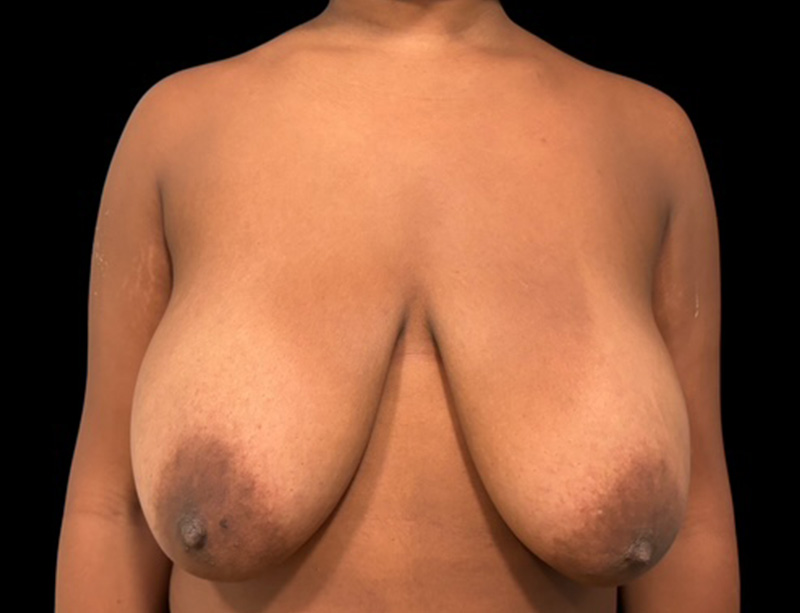 Breast Reduction Before & After Gallery - Patient 201116 - Image 1