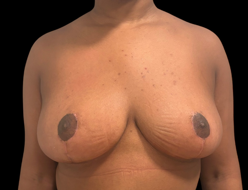 Breast Reduction Before & After Gallery - Patient 201116 - Image 2