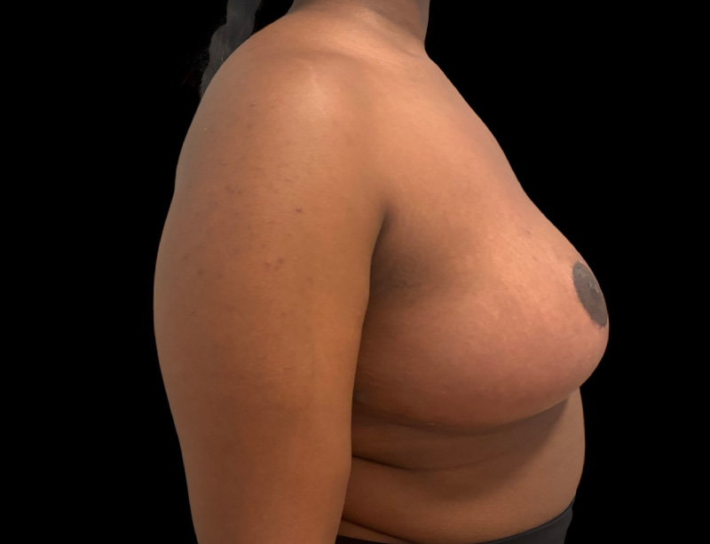Breast Reduction Before & After Gallery - Patient 201116 - Image 4