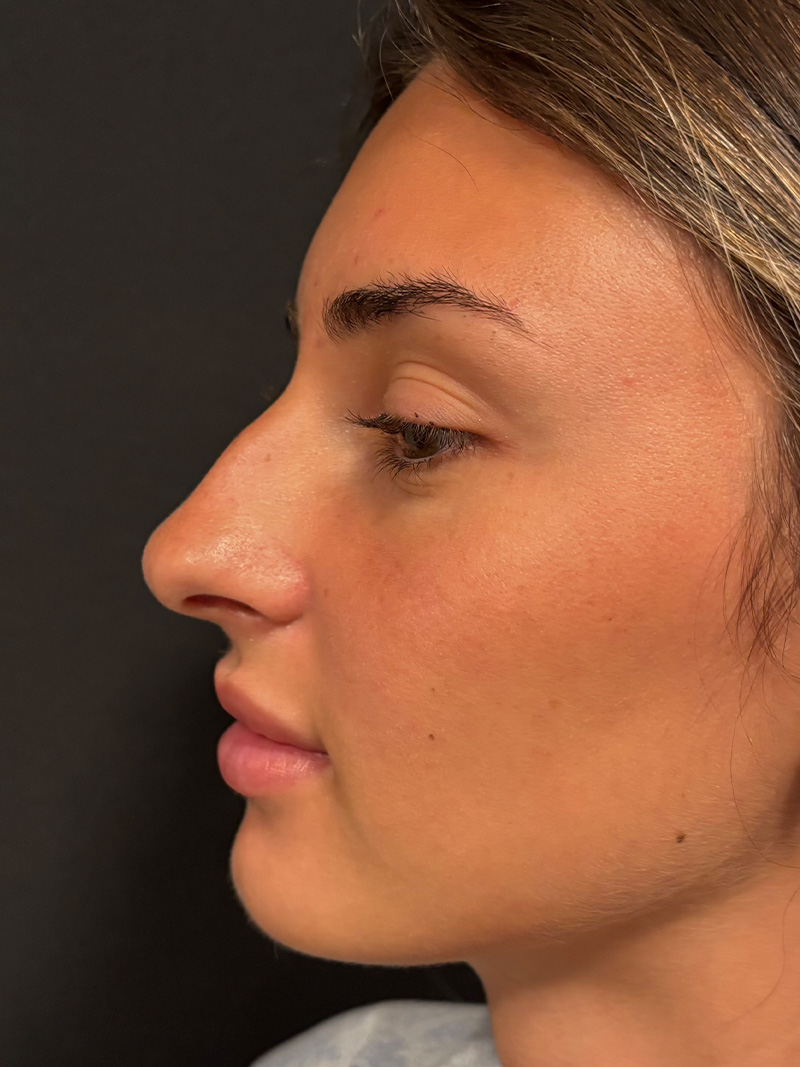 Rhinoplasty Before & After Gallery - Patient 345507 - Image 1