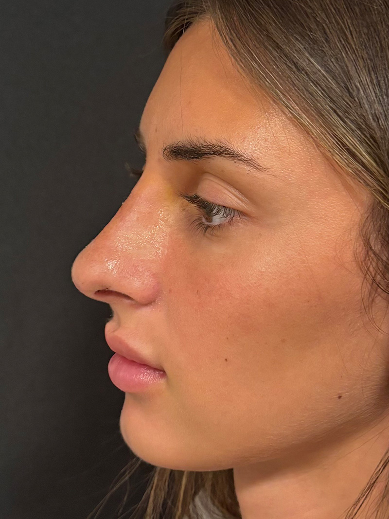 Rhinoplasty Before & After Gallery - Patient 345507 - Image 2