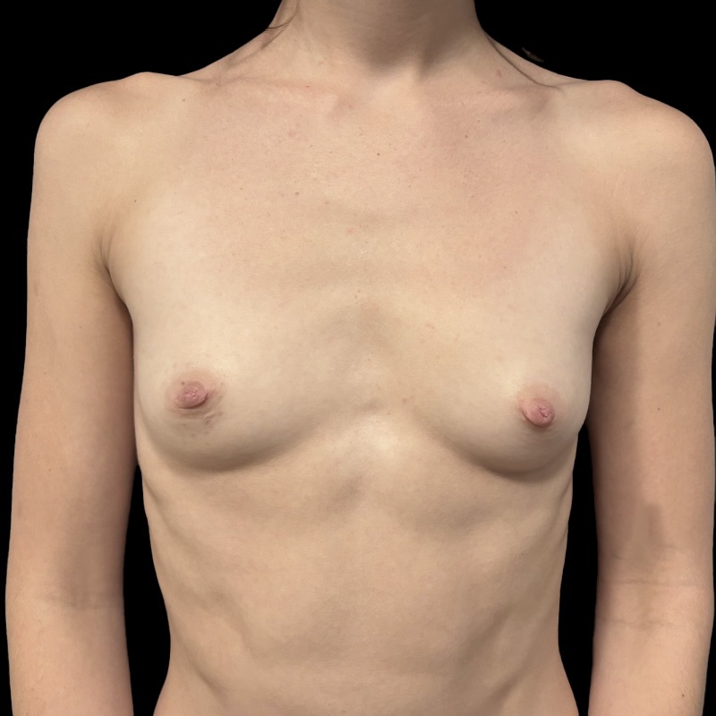 Breast Augmentation Before & After Gallery - Patient 139904 - Image 1