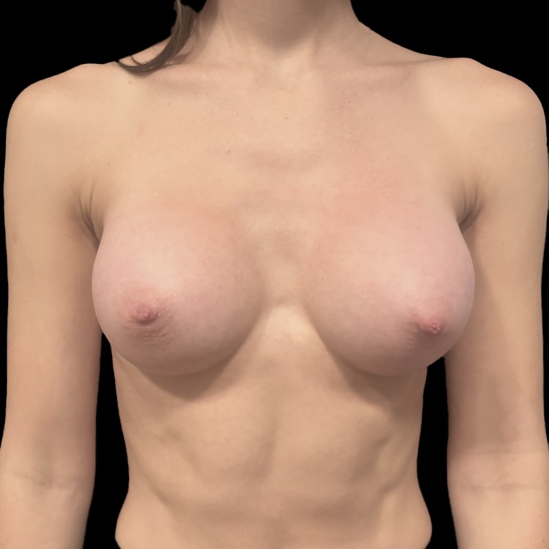 Breast Augmentation Before & After Gallery - Patient 139904 - Image 2