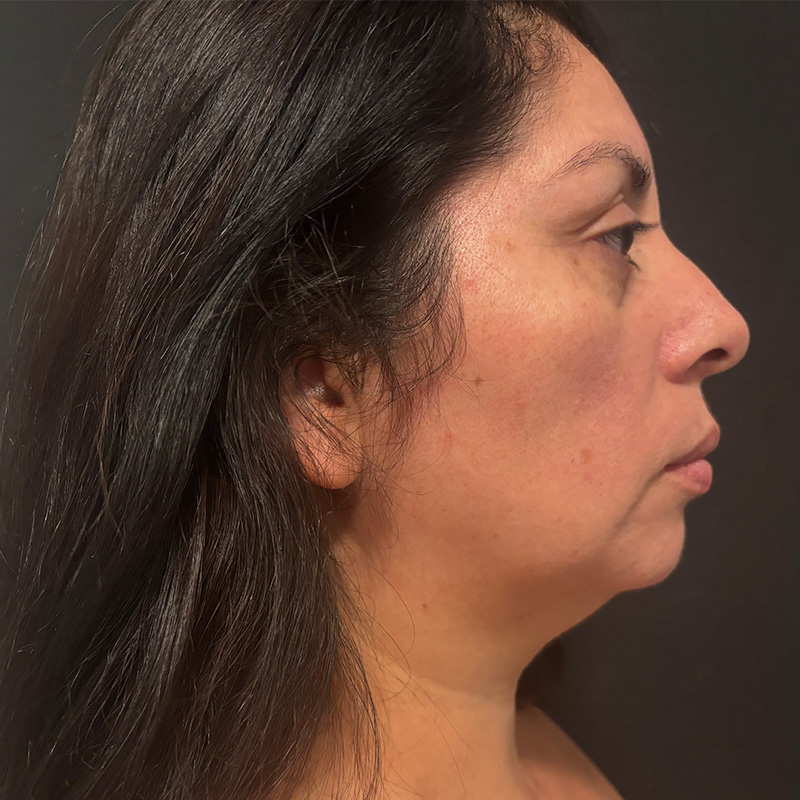 Liposuction Before & After Gallery - Patient 324798 - Image 1