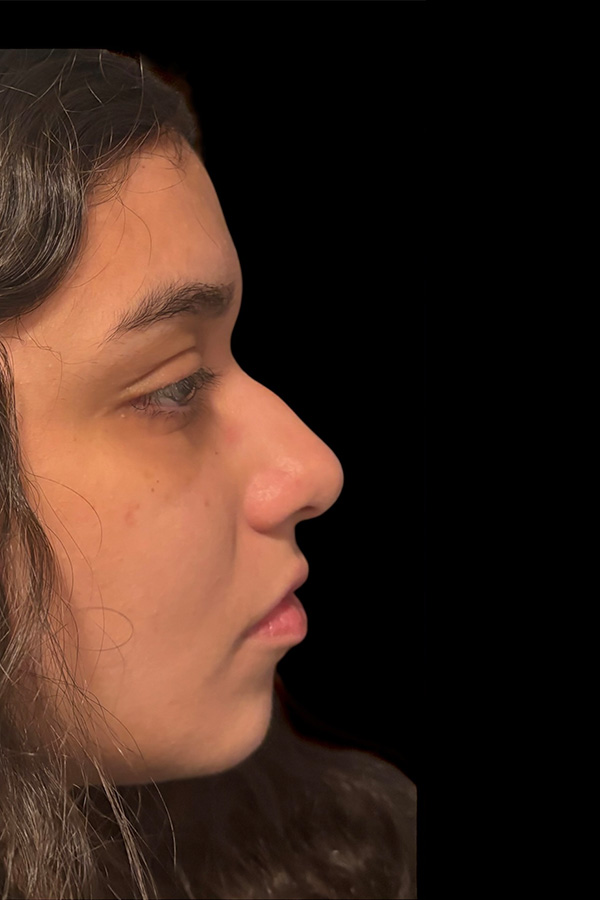 Rhinoplasty Before & After Gallery - Patient 122133 - Image 1