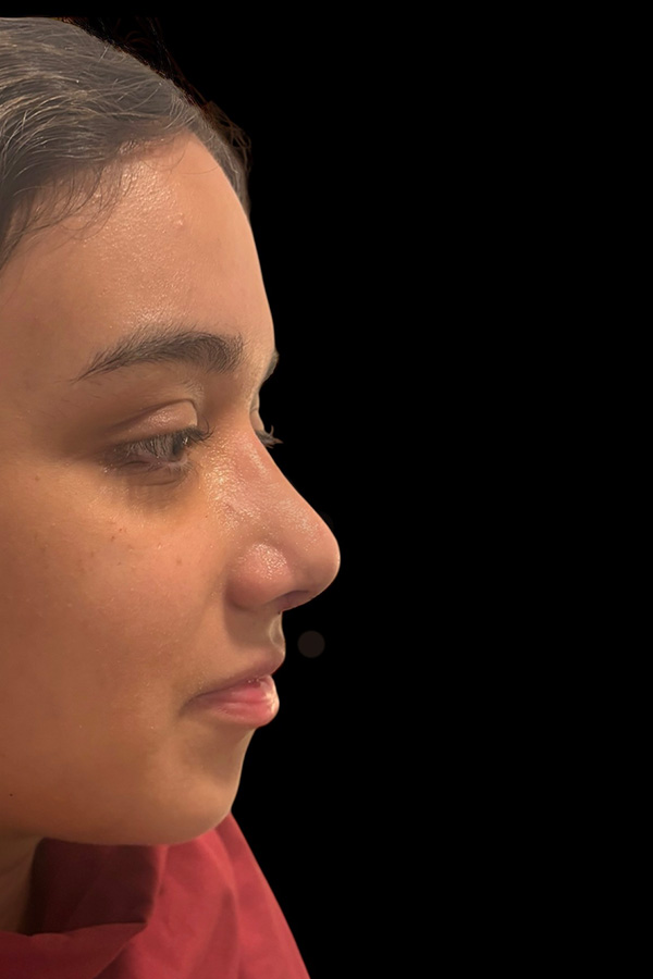 Rhinoplasty Before & After Gallery - Patient 122133 - Image 2