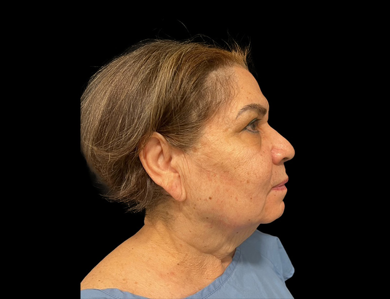 Facelift Before & After Gallery - Patient 77369274 - Image 1