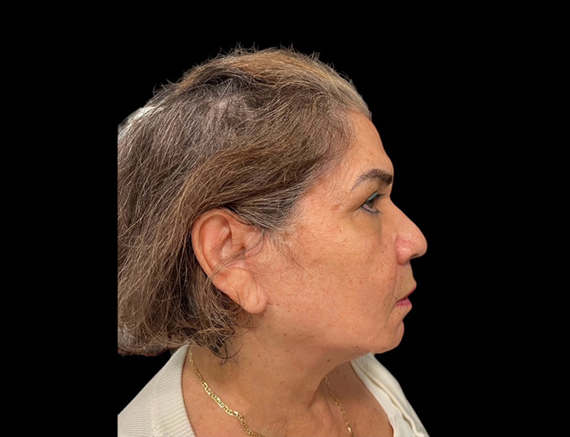 Facelift Before & After Gallery - Patient 77369274 - Image 2