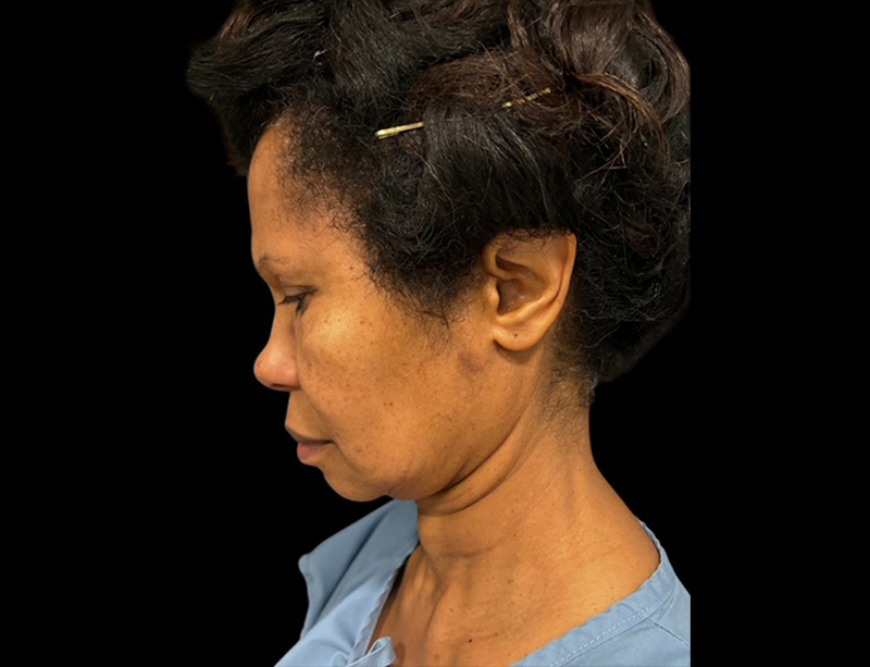 Facelift Before & After Gallery - Patient 430418 - Image 1