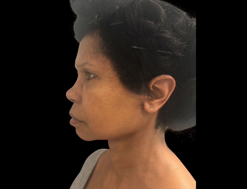 Facelift Before & After Gallery - Patient 430418 - Image 2
