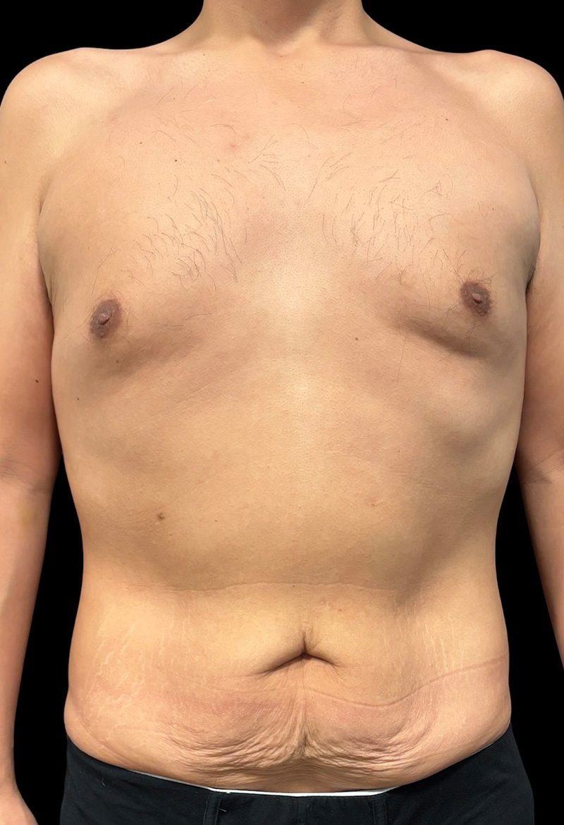 Male Abdominoplasty Before & After Gallery - Patient 132274 - Image 1
