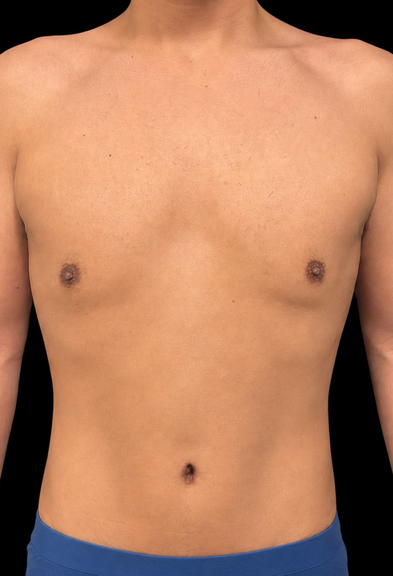 Male Abdominoplasty Before & After Gallery - Patient 132274 - Image 2