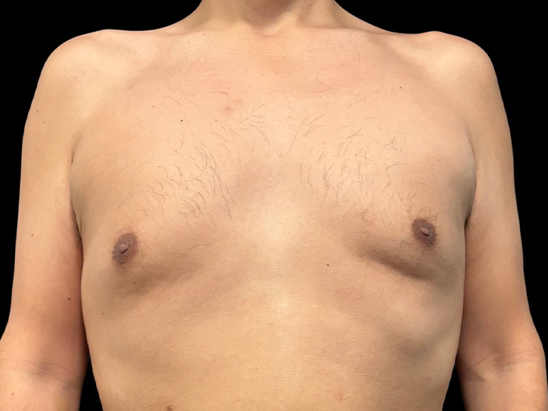 Gynecomastia Before & After Gallery - Patient 346277 - Image 1