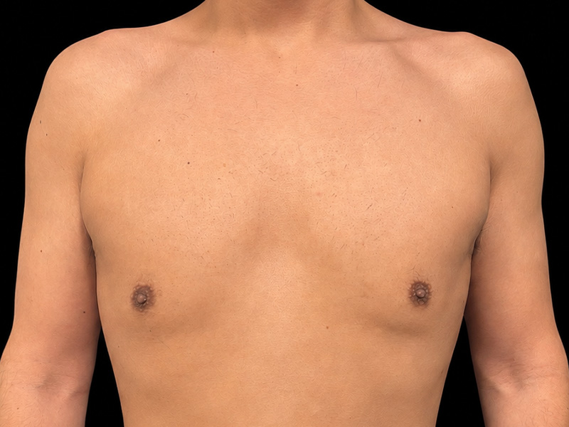 Gynecomastia Before & After Gallery - Patient 346277 - Image 2