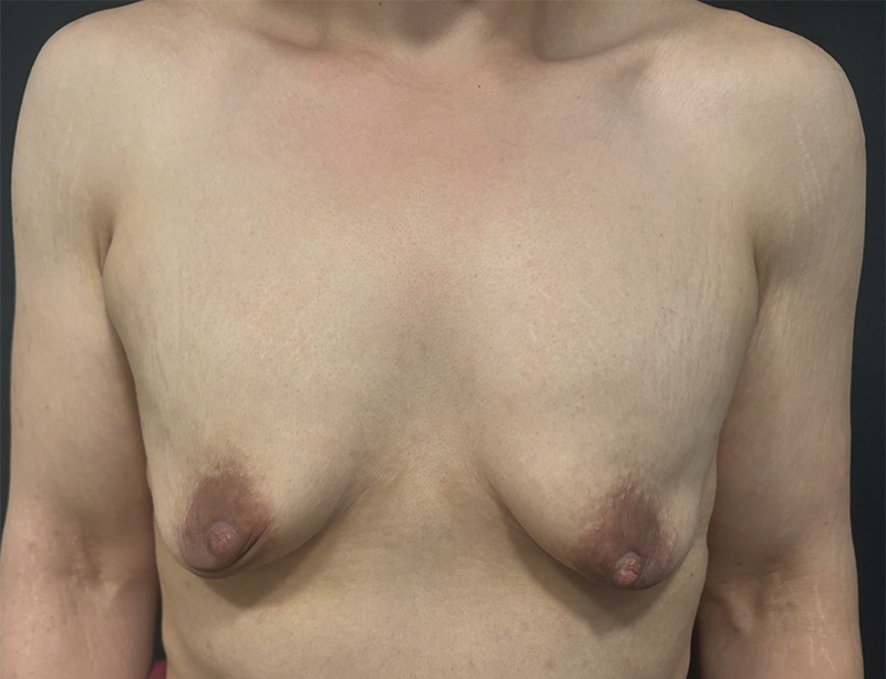 Breast Lift Before & After Gallery - Patient 157578 - Image 1