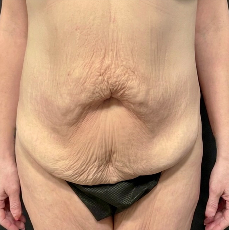 Abdominoplasty Before & After Gallery - Patient 495029 - Image 1