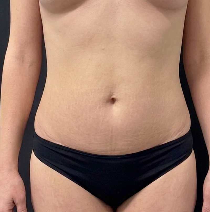 Abdominoplasty Before & After Gallery - Patient 495029 - Image 2