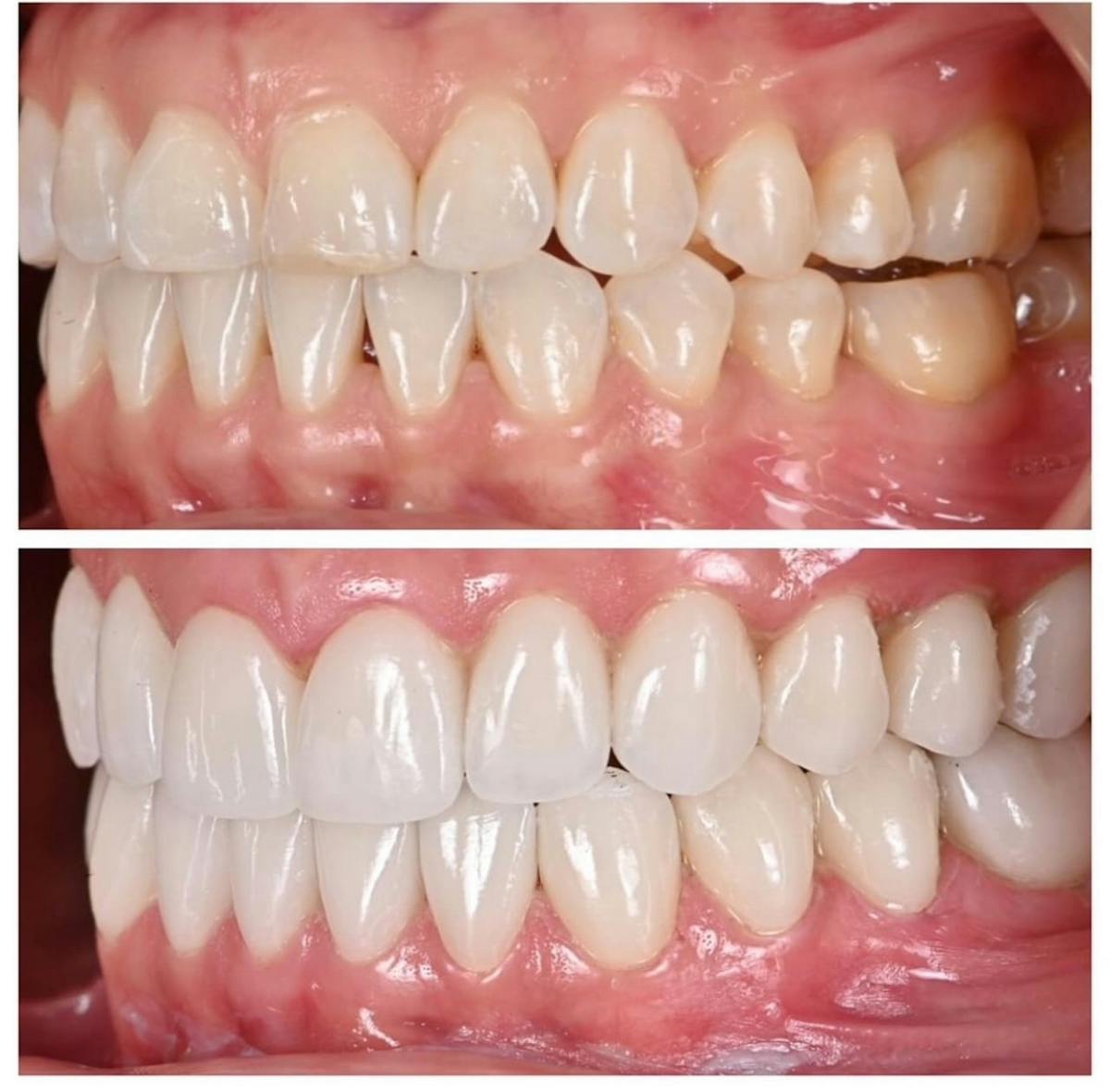 Smile Makeover Before & After Gallery - Patient 366367 - Image 1
