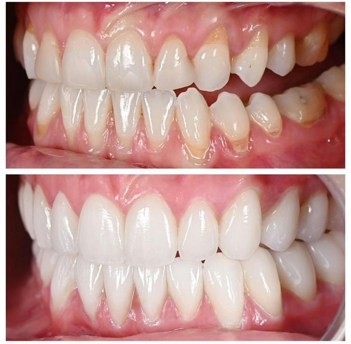 Smile Makeover Before & After Gallery - Patient 271944 - Image 1