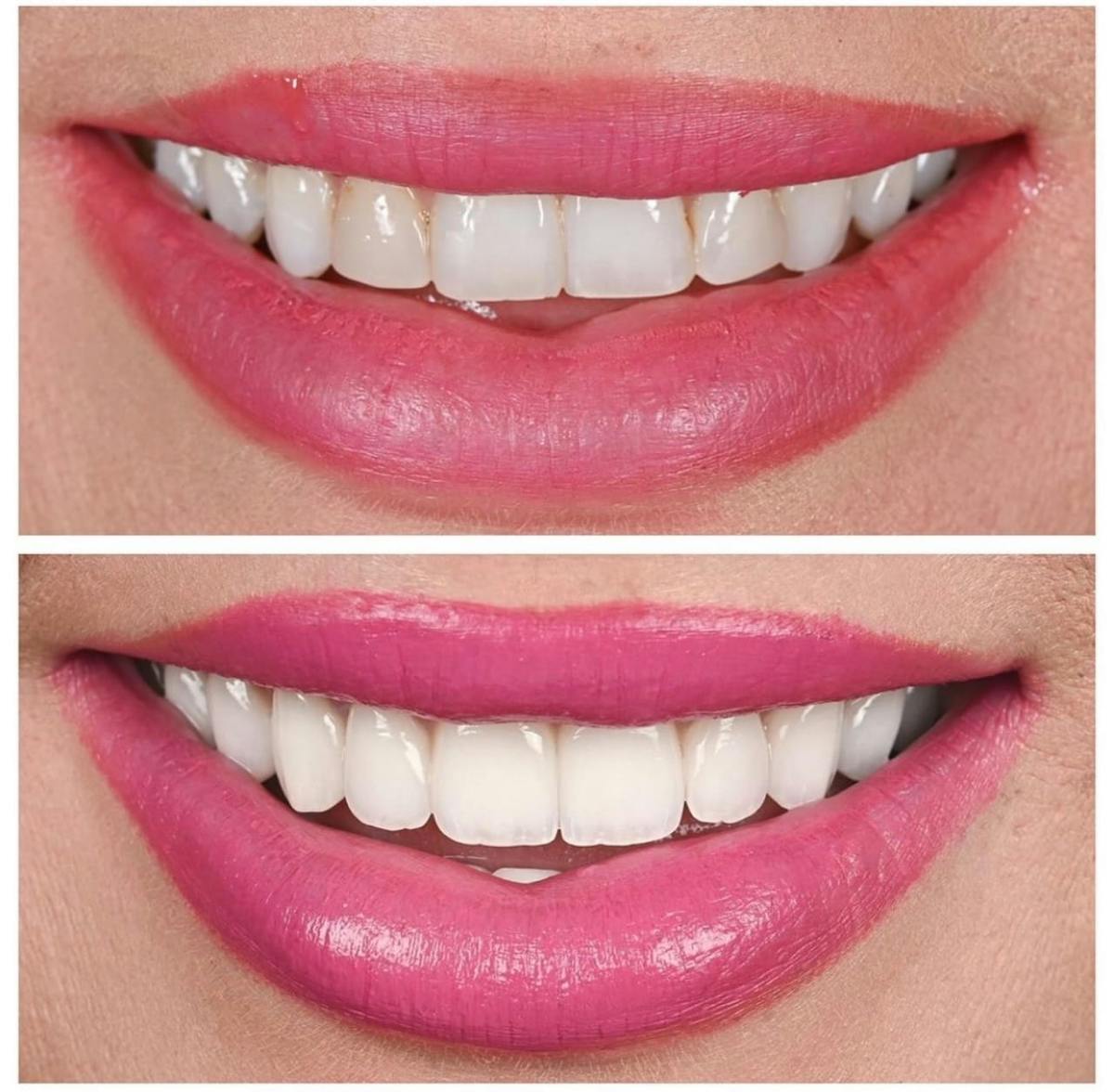 Smile Makeover Before & After Gallery - Patient 364021 - Image 1