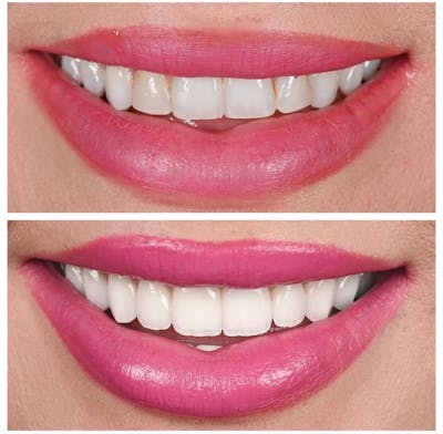 Smile Makeover Before & After Gallery - Patient 364021 - Image 1