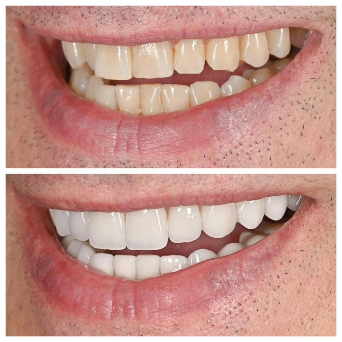 Smile Makeover Before & After Gallery - Patient 100981 - Image 2