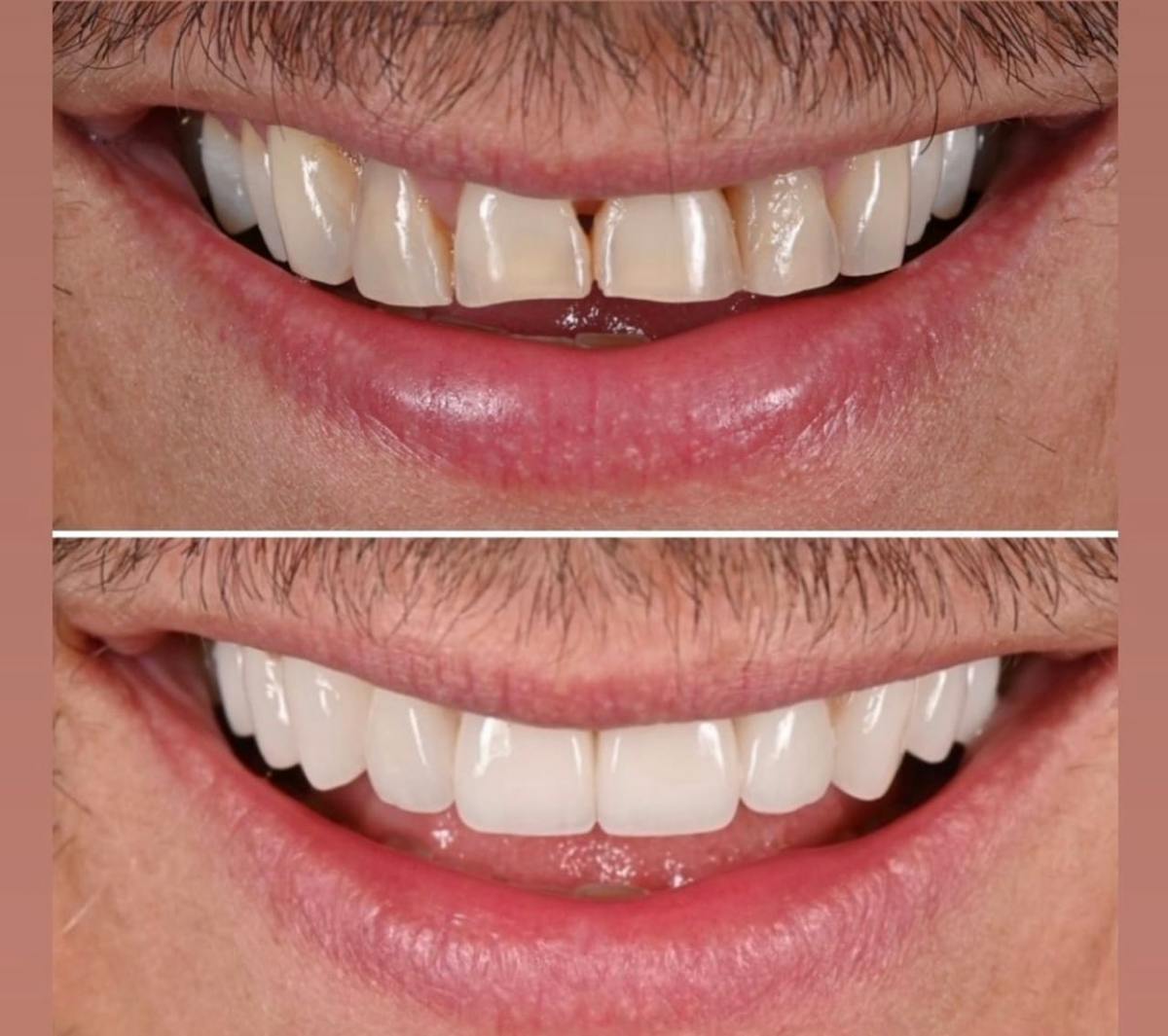 Smile Makeover Before & After Gallery - Patient 119603 - Image 1