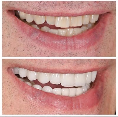 Smile Makeover Before & After Gallery - Patient 100981 - Image 1
