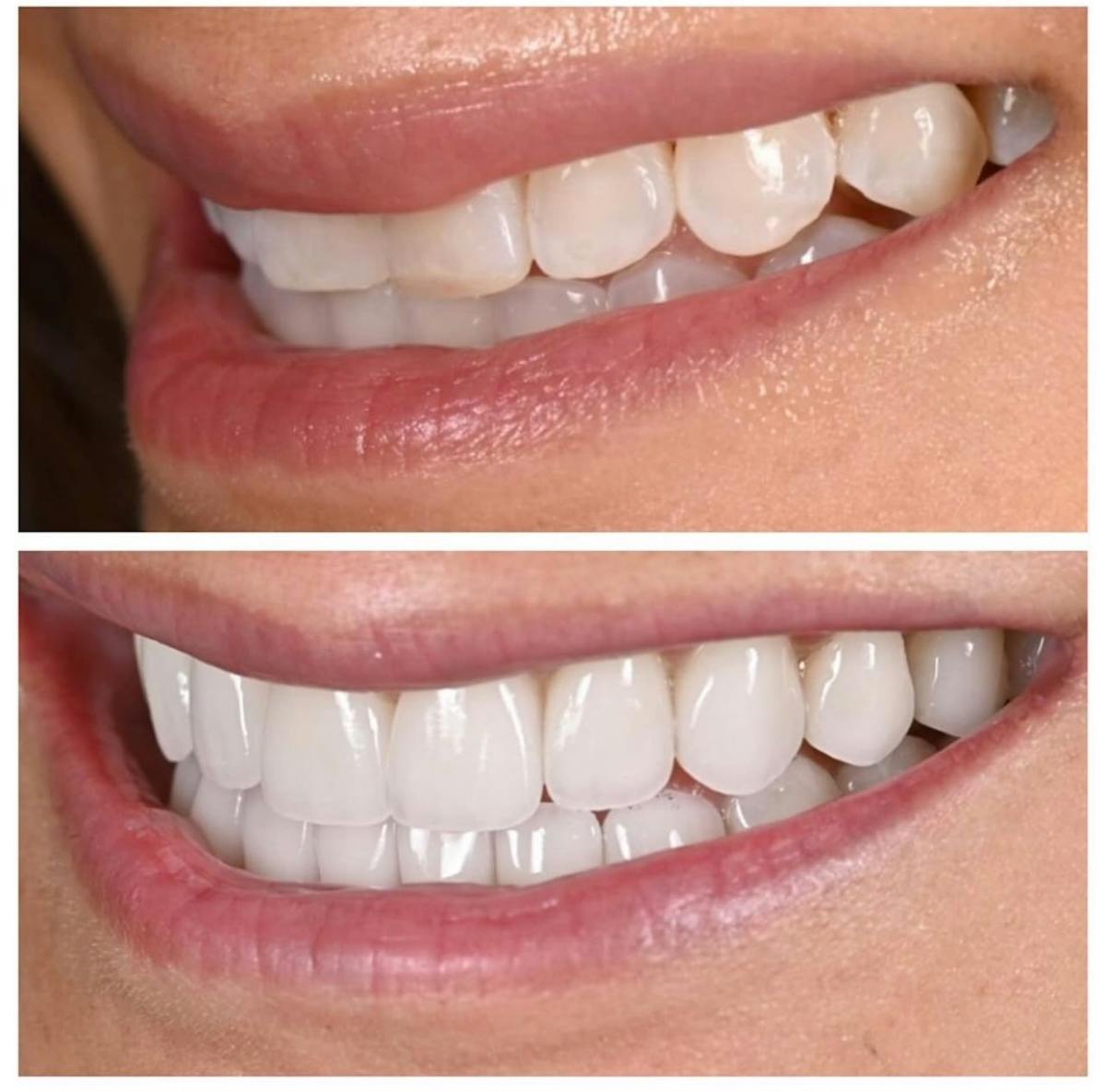 Smile Makeover Before & After Gallery - Patient 342417 - Image 1
