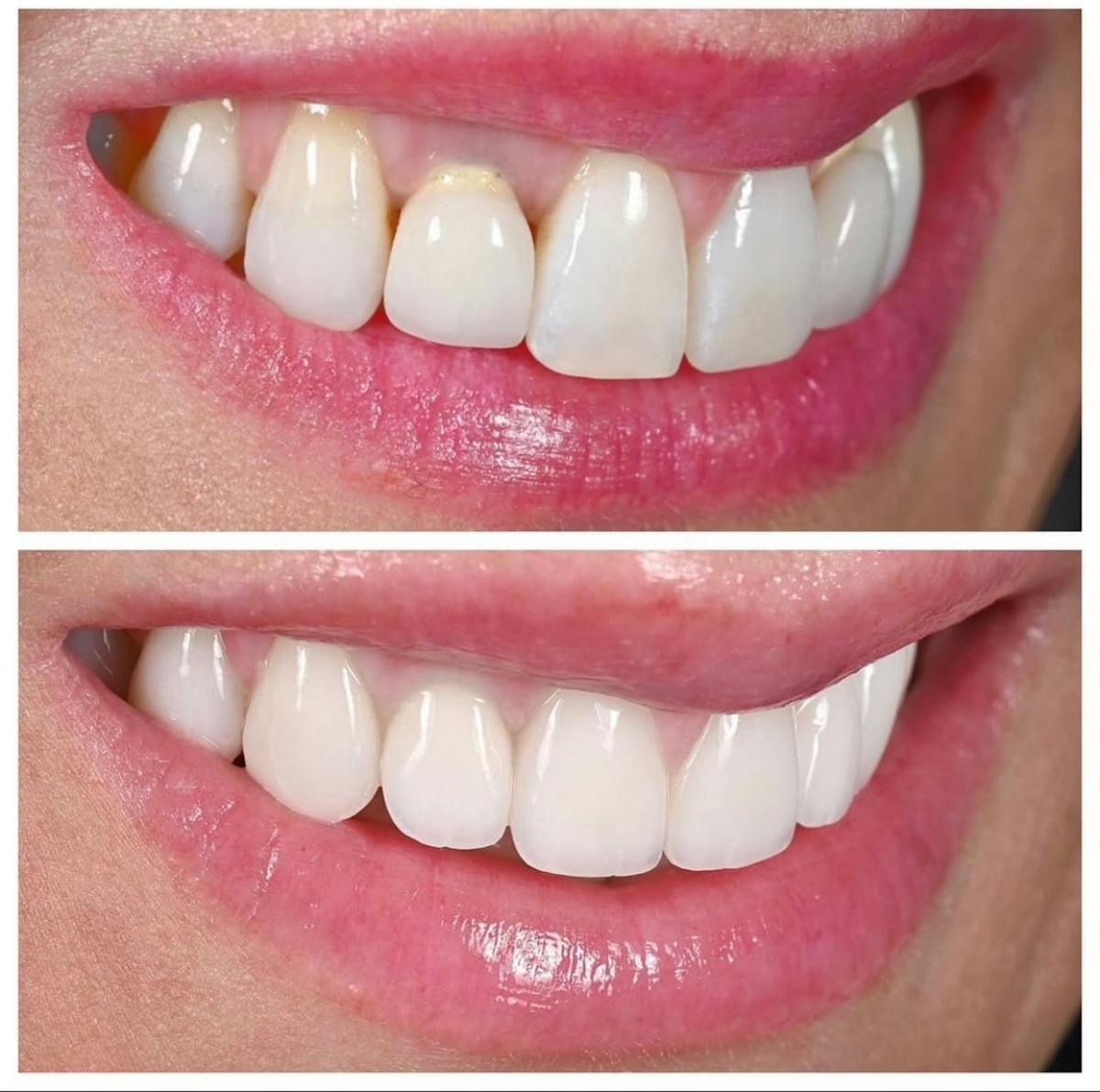 Smile Makeover Before & After Gallery - Patient 336921 - Image 3