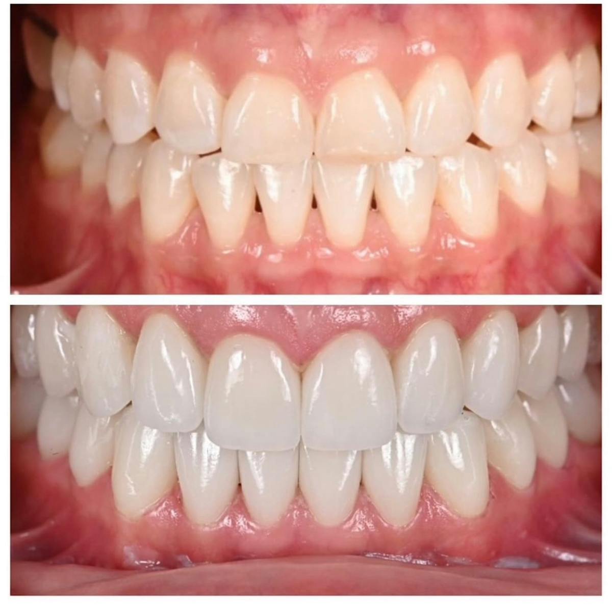 Smile Makeover Before & After Gallery - Patient 169491 - Image 1