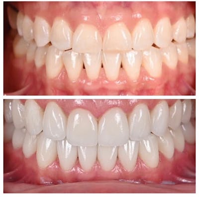 Smile Makeover Before & After Gallery - Patient 169491 - Image 1