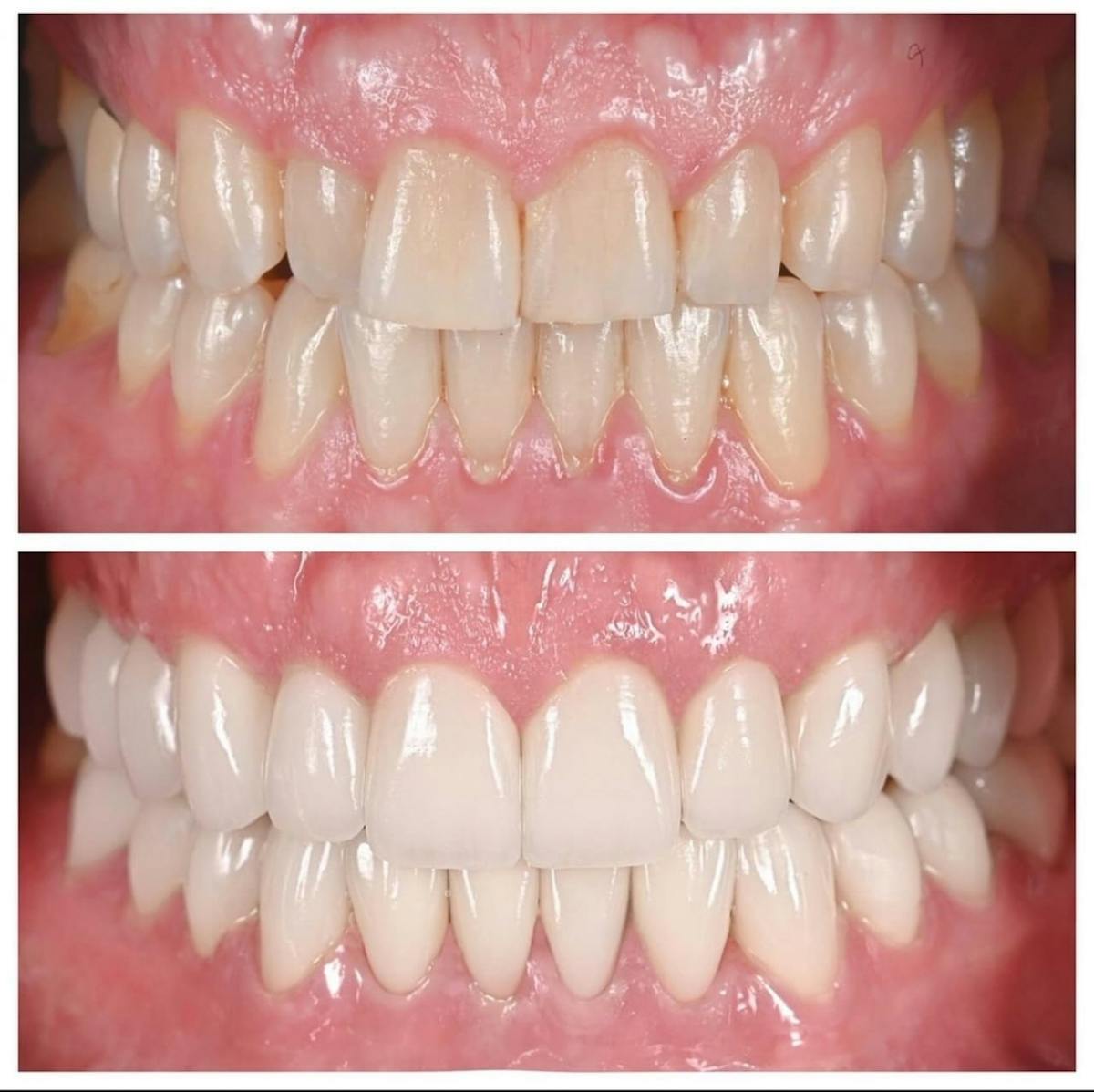 Smile Makeover Before & After Gallery - Patient 288815 - Image 1