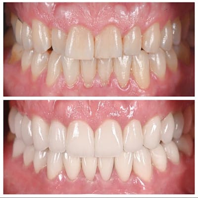 Smile Makeover Before & After Gallery - Patient 288815 - Image 1