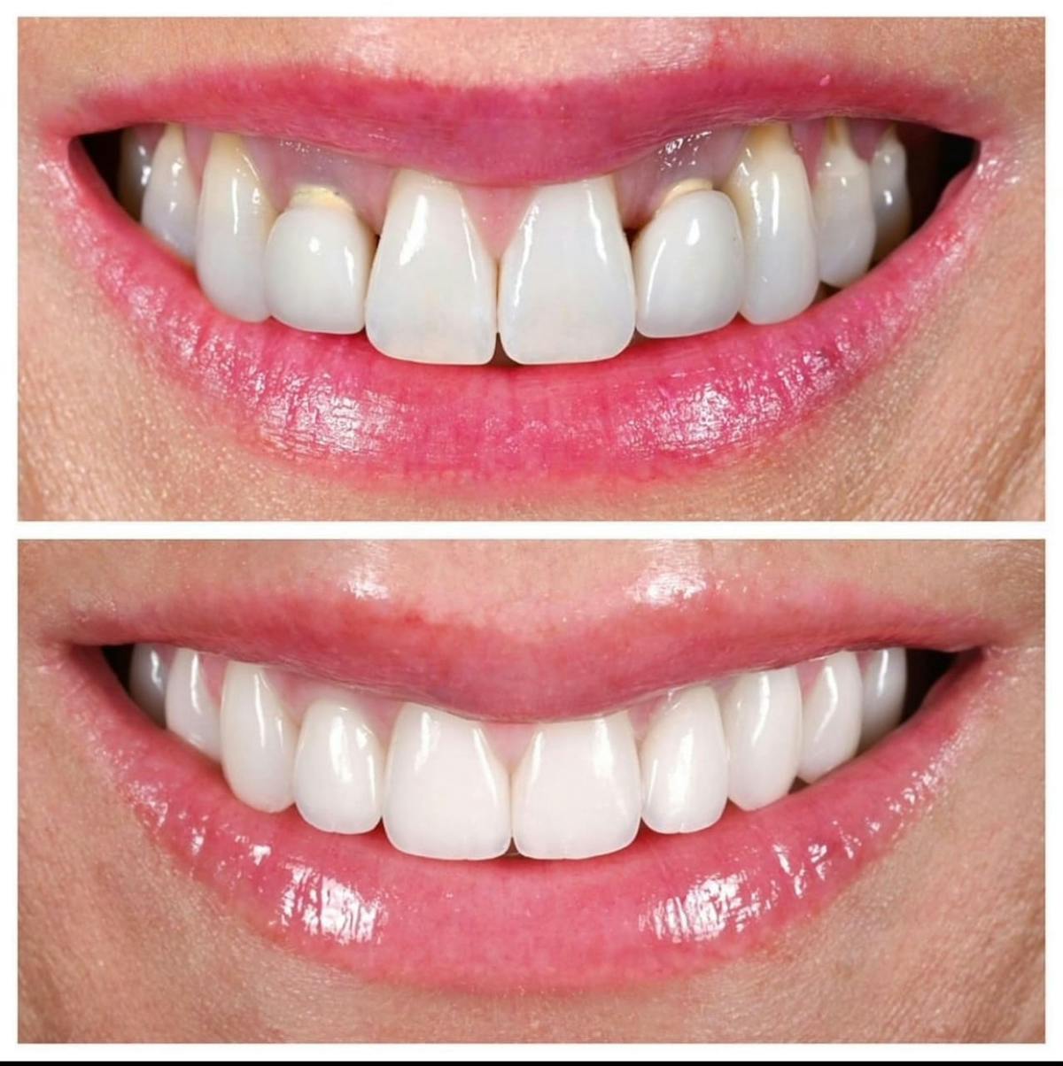 Smile Makeover Before & After Gallery - Patient 336921 - Image 2