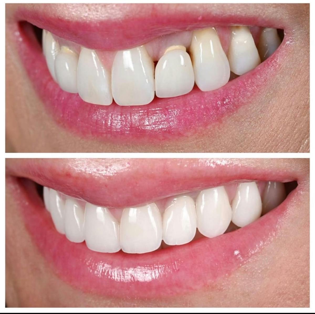 Smile Makeover Before & After Gallery - Patient 336921 - Image 1