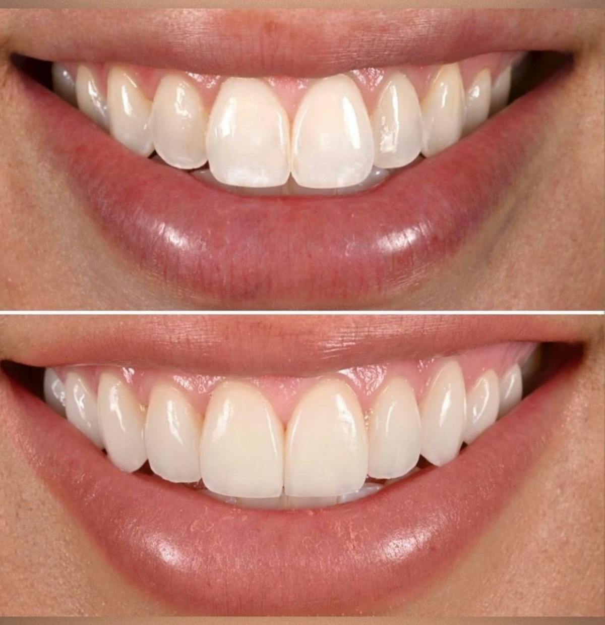 Smile Makeover Before & After Gallery - Patient 277989 - Image 1