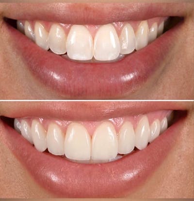 Smile Makeover Before & After Gallery - Patient 277989 - Image 1